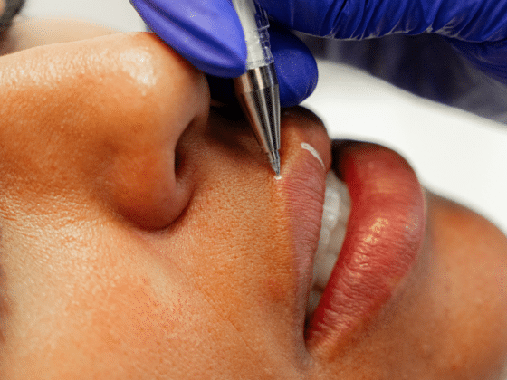 Determining the Right Amount of Lip Filler for You