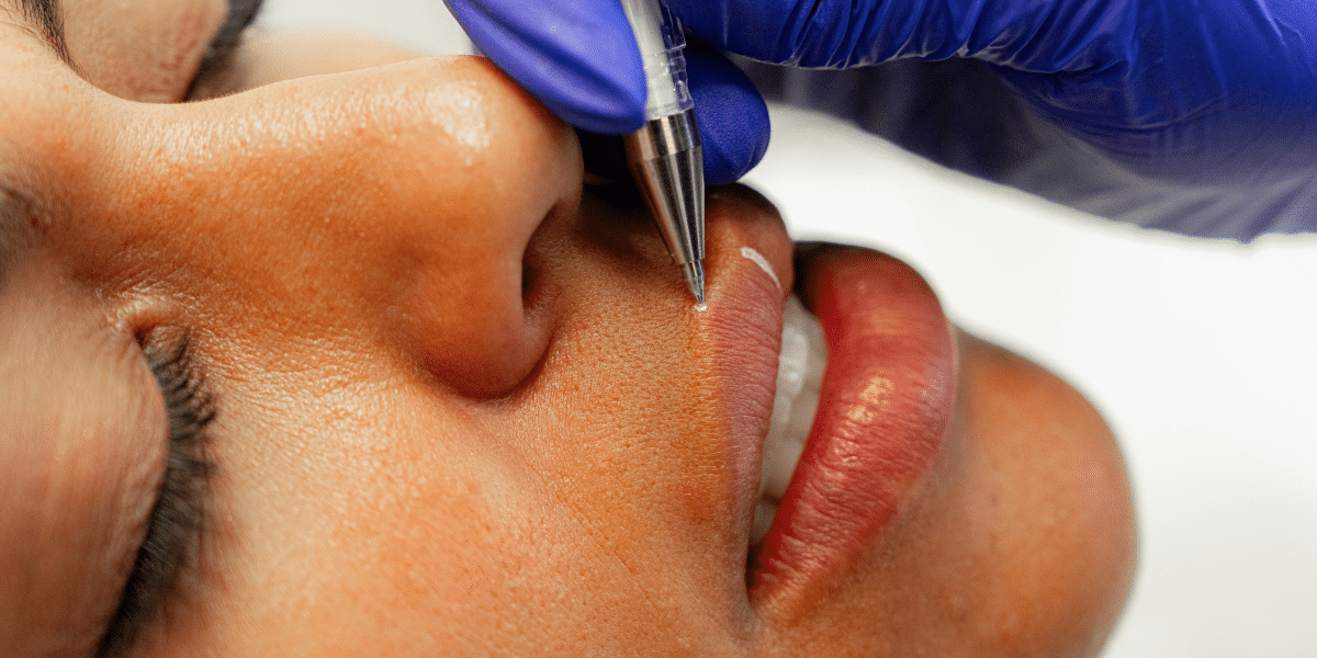 Determining the Right Amount of Lip Filler for You